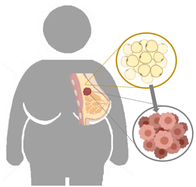 Rôle des cellules myoépithéliales dans le développement du cancer du sein