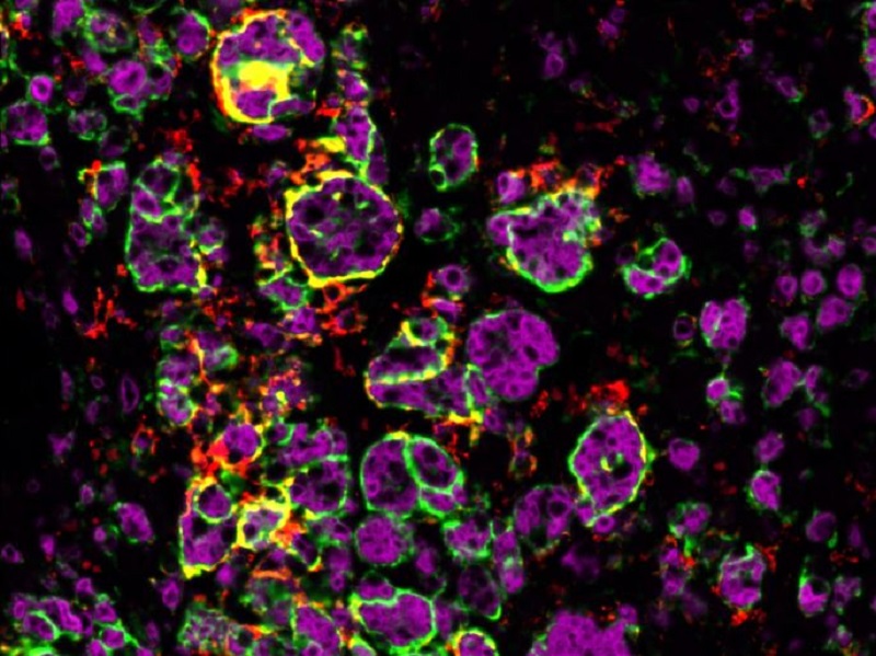 Macrophages attaquant la tumeur surrénalienne d’une souris mâle. © Julie Olabe CNRS/GReD